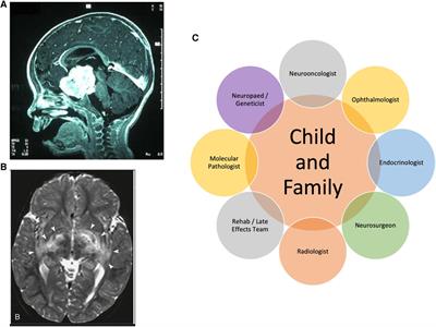 A new era for optic pathway glioma: A developmental brain tumor with life-long health consequences